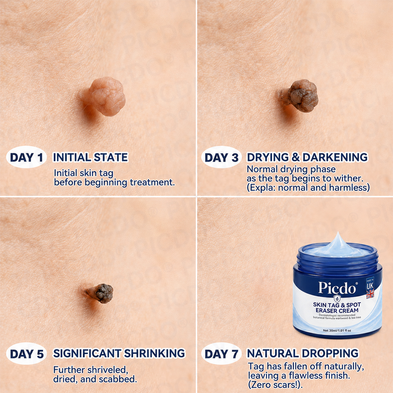 𝐏𝐢𝐜𝐝𝐨® 7-𝐃𝐚𝐲 𝐒𝐤𝐢𝐧 𝐓𝐚𝐠 & 𝐒𝐩𝐨𝐭 𝐄𝐫𝐚𝐬𝐞𝐫 𝐂𝐫𝐞𝐚𝐦 (Zero Pain, Zero 𝐒𝐜𝐚𝐫𝐬 Formula) 🌹🌹