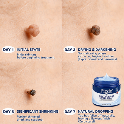 𝐏𝐢𝐜𝐝𝐨® 7-𝐃𝐚𝐲 𝐒𝐤𝐢𝐧 𝐓𝐚𝐠 & 𝐒𝐩𝐨𝐭 𝐄𝐫𝐚𝐬𝐞𝐫 𝐂𝐫𝐞𝐚𝐦 (Zero Pain, Zero 𝐒𝐜𝐚𝐫𝐬 Formula) 🌹🌹