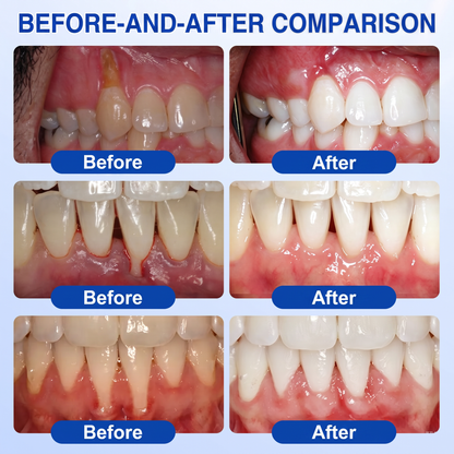𝐆𝐥𝐢𝐦𝐦𝐞𝐫𝐥𝐲® 👀GumRevive periodontal repair gel💪
