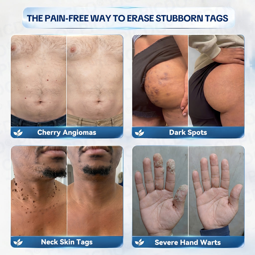 𝐏𝐢𝐜𝐝𝐨® 7-𝐃𝐚𝐲 𝐒𝐤𝐢𝐧 𝐓𝐚𝐠 & 𝐒𝐩𝐨𝐭 𝐄𝐫𝐚𝐬𝐞𝐫 𝐂𝐫𝐞𝐚𝐦 (Zero Pain, Zero 𝐒𝐜𝐚𝐫𝐬 Formula) 🌹🌹