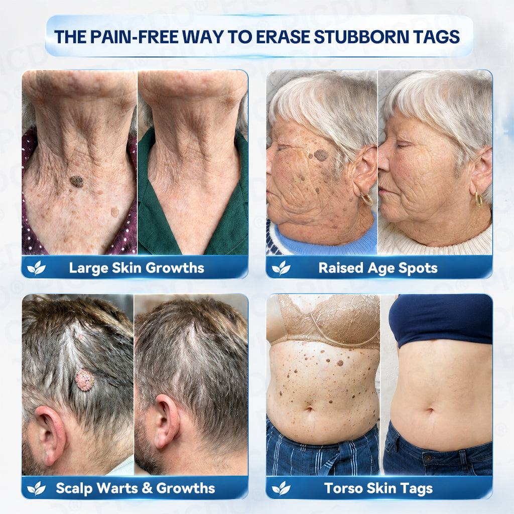 𝐏𝐢𝐜𝐝𝐨® 7-𝐃𝐚𝐲 𝐒𝐤𝐢𝐧 𝐓𝐚𝐠 & 𝐒𝐩𝐨𝐭 𝐄𝐫𝐚𝐬𝐞𝐫 𝐂𝐫𝐞𝐚𝐦 (Zero Pain, Zero 𝐒𝐜𝐚𝐫𝐬 Formula) 🌹🌹
