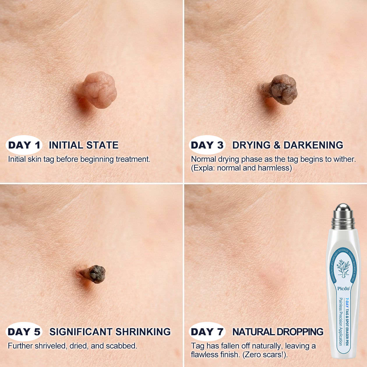 𝐏i𝐜𝐝o®🩹🚀7-𝐷𝑎𝑦 𝗧𝐚𝐠 & 𝗦𝗽𝐨𝐭 𝐄𝐫𝒂𝒔𝒆𝒓(Zero Pain, Zero 𝐒𝐜𝐚𝒓𝒔 Rollerball)