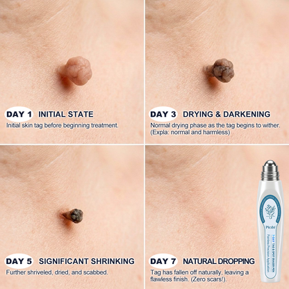 𝐏i𝐜𝐝o®🩹🚀7-𝐷𝑎𝑦 𝗧𝐚𝐠 & 𝗦𝗽𝐨𝐭 𝐄𝐫𝒂𝒔𝒆𝒓(Zero Pain, Zero 𝐒𝐜𝐚𝒓𝒔 Rollerball)